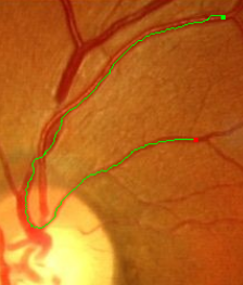 Blood vessels in a retina image